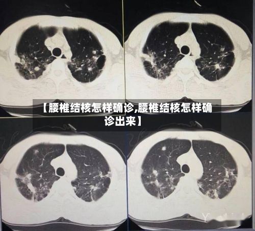 【腰椎结核怎样确诊,腰椎结核怎样确诊出来】