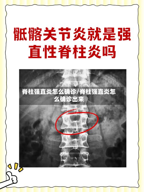 脊柱强直炎怎么确诊/脊柱强直炎怎么确诊出来