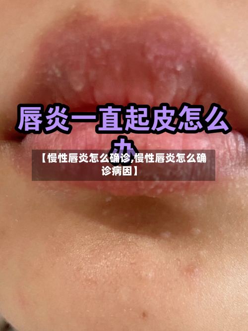 【慢性唇炎怎么确诊,慢性唇炎怎么确诊病因】-第2张图片