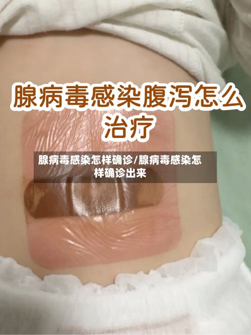 腺病毒感染怎样确诊/腺病毒感染怎样确诊出来