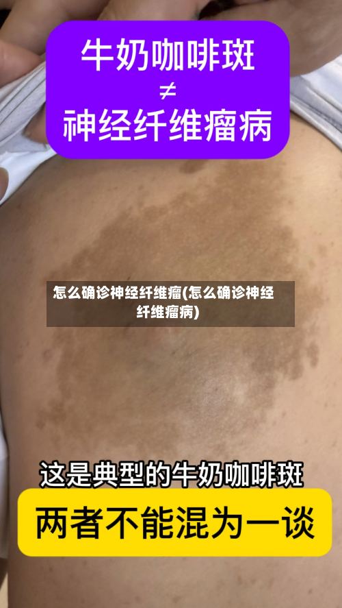 怎么确诊神经纤维瘤(怎么确诊神经纤维瘤病)