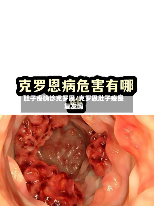 肚子疼确诊克罗恩/克罗恩肚子疼是复发吗