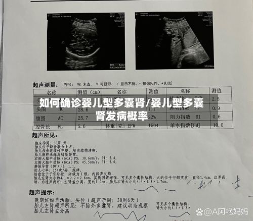 如何确诊婴儿型多囊肾/婴儿型多囊肾发病概率
