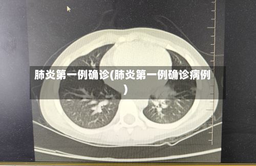 肺炎第一例确诊(肺炎第一例确诊病例)-第3张图片