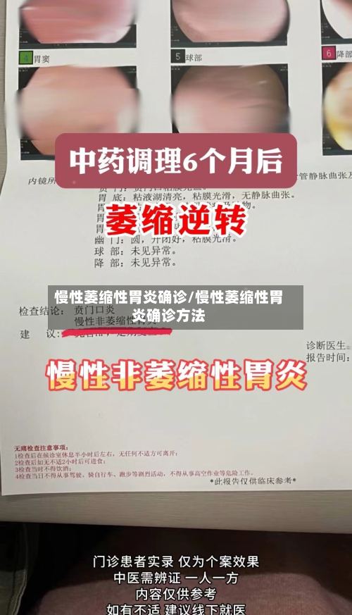 慢性萎缩性胃炎确诊/慢性萎缩性胃炎确诊方法