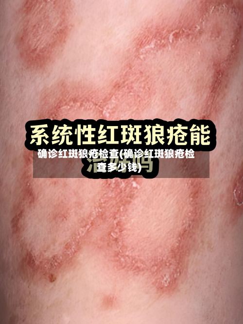 确诊红斑狼疮检查(确诊红斑狼疮检查多少钱)-第2张图片