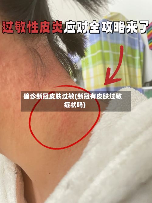 确诊新冠皮肤过敏(新冠有皮肤过敏症状吗)-第2张图片