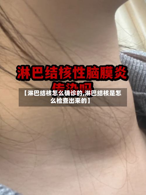 【淋巴结核怎么确诊的,淋巴结核是怎么检查出来的】